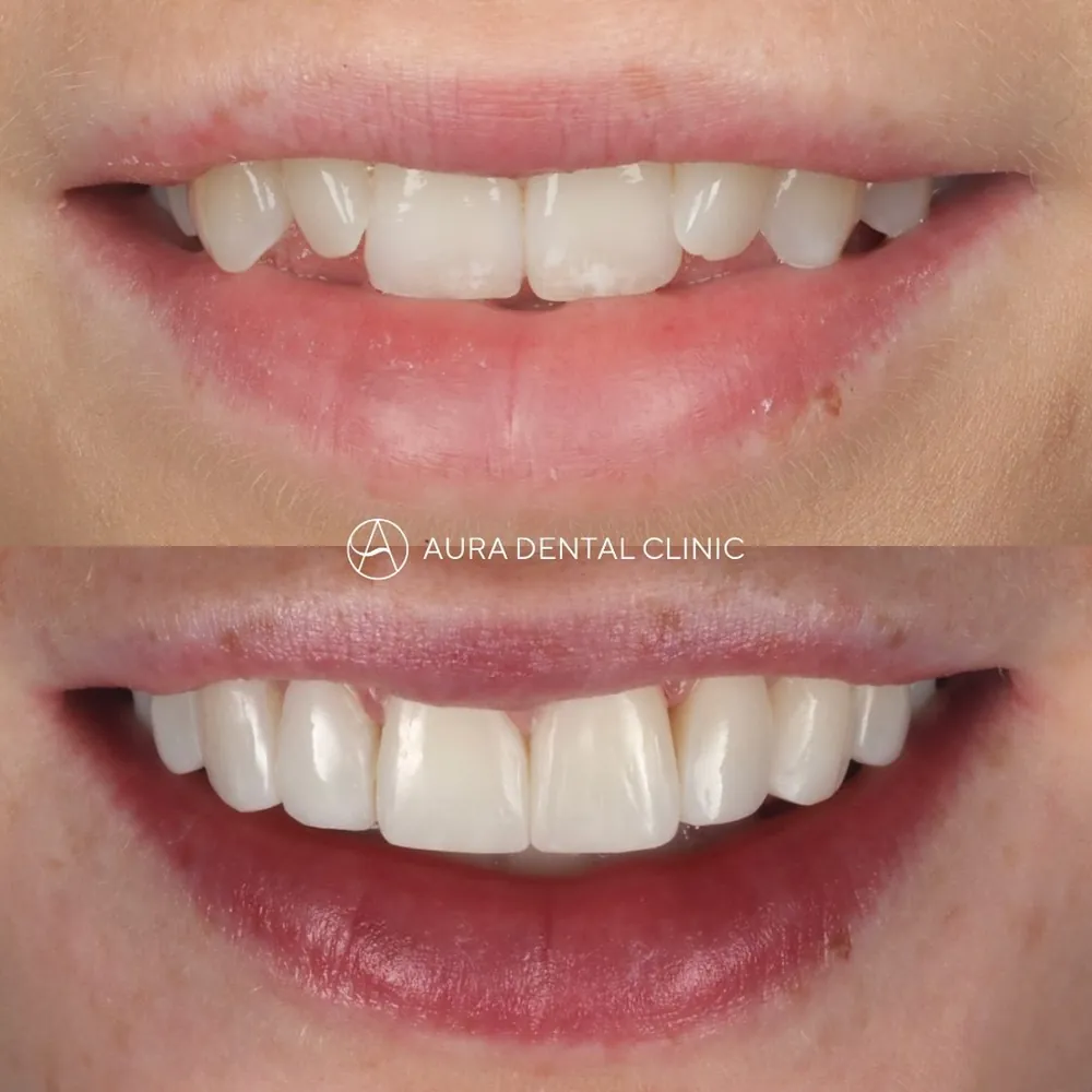 Before and after: Invisalign®, whitening and bonding