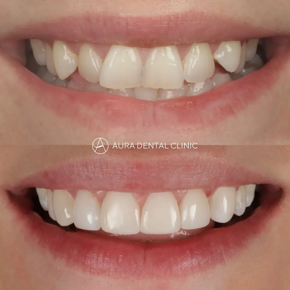 Before and after: Invisalign®, whitening and 6 bonded teeth