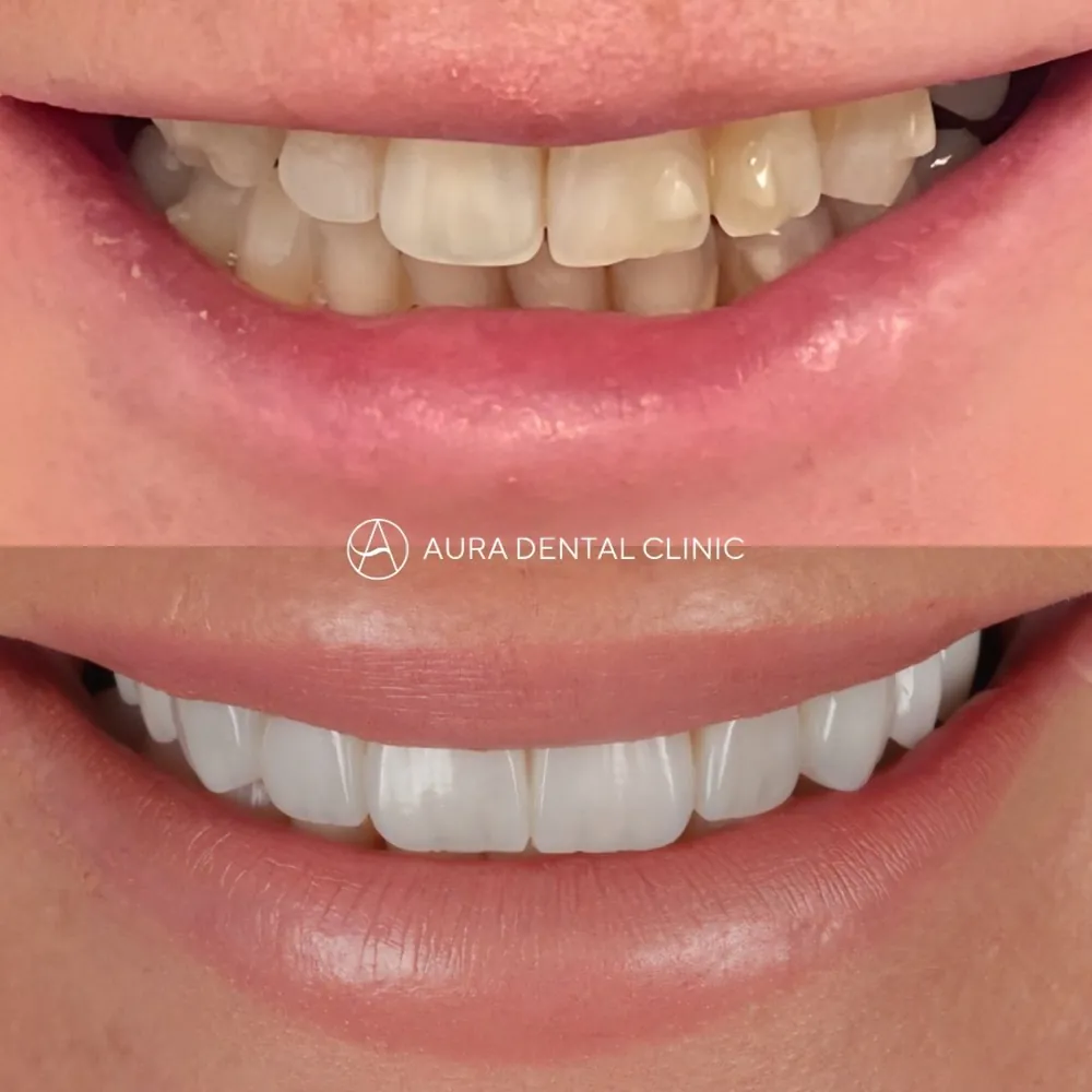 Before and after: Invisalign®, then Halo Veneers