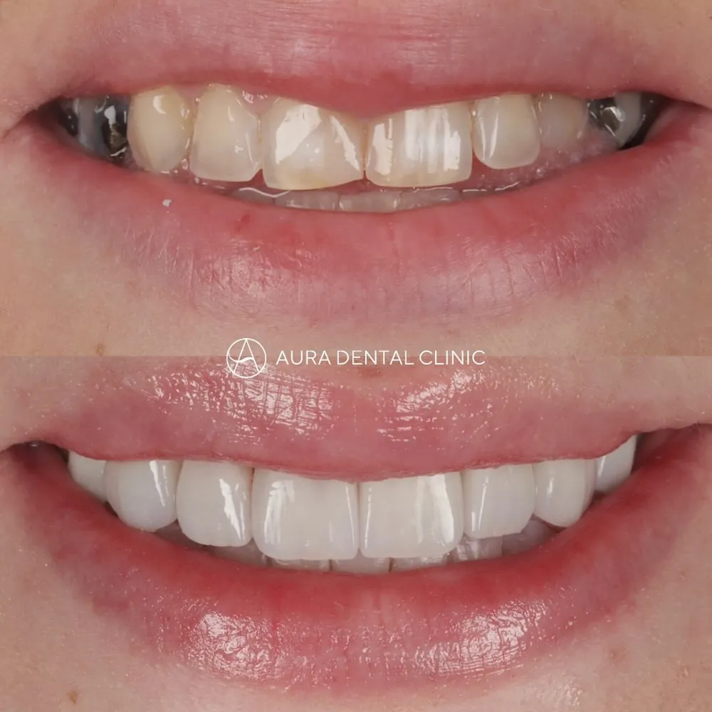Before and after: Invisalign® and 8 Halo Veneers