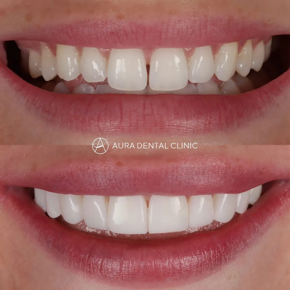 Before and after: 10 composite veneers in under 3 hours