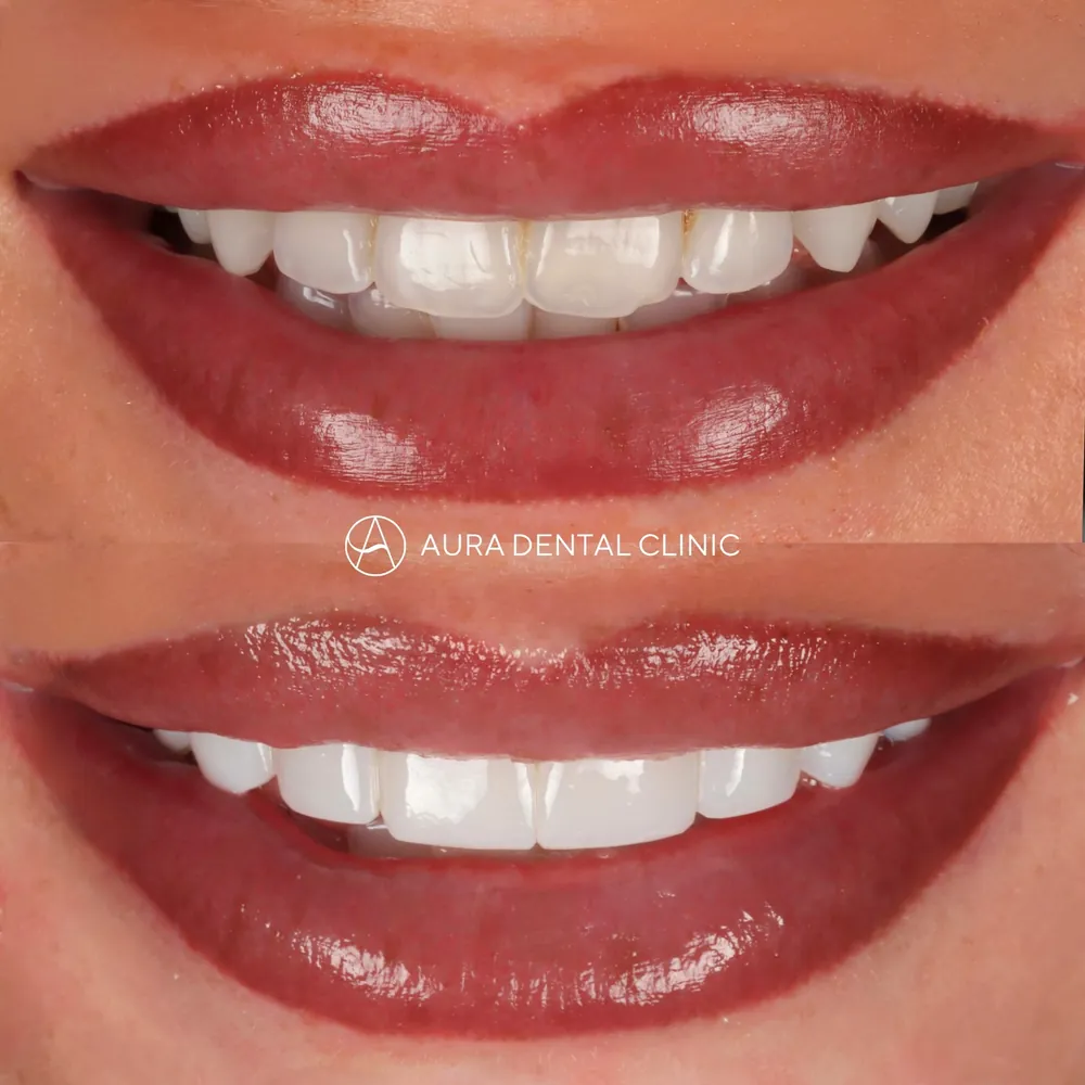 Before and after: Composite bonding, shape and colour refined