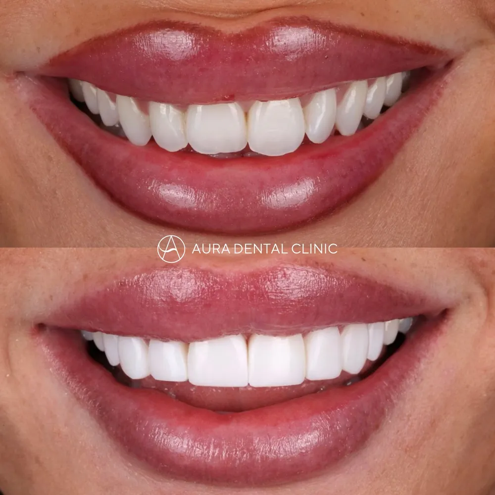 Before and after: Composite veneers smile makeover