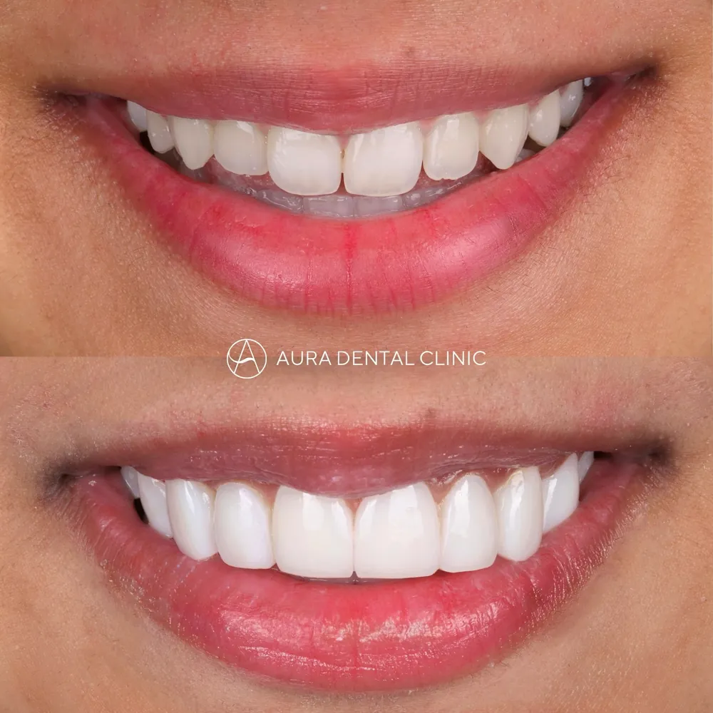 Before and after: Composite veneers, a fuller smile