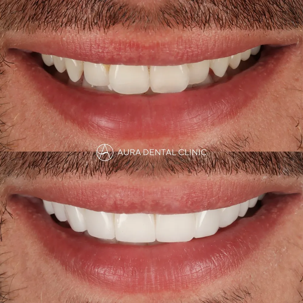 Before and after: Composite bonding, worn edges rebuilt