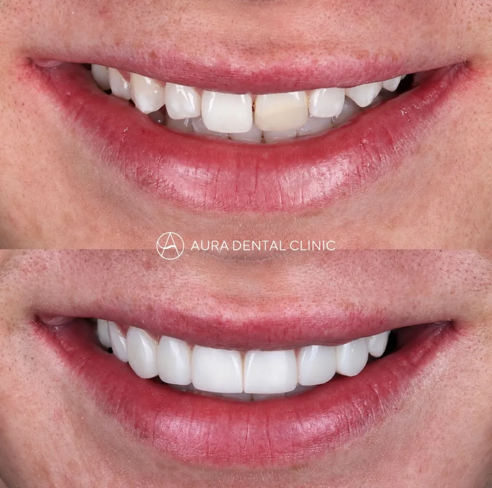 Before and after: Composite bonding, gaps and edges evened out