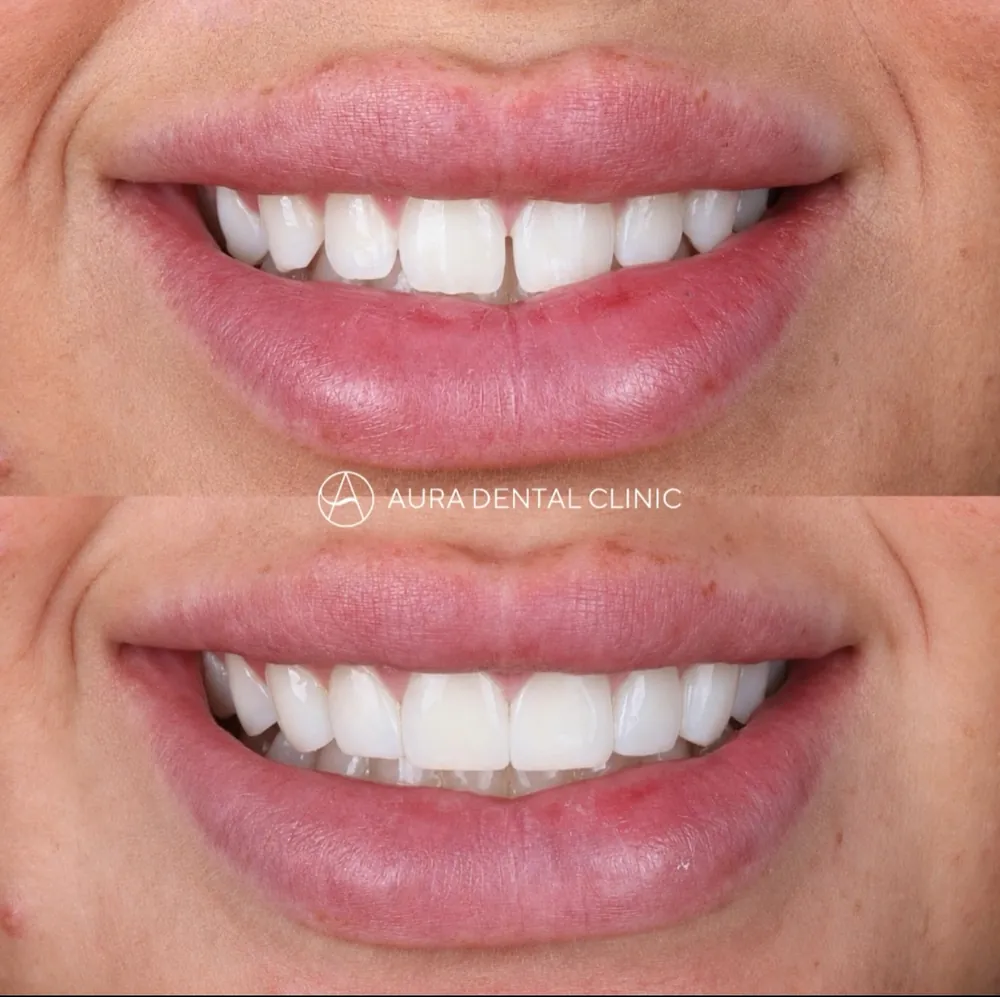 Before and after: Composite bonding, front gap closed