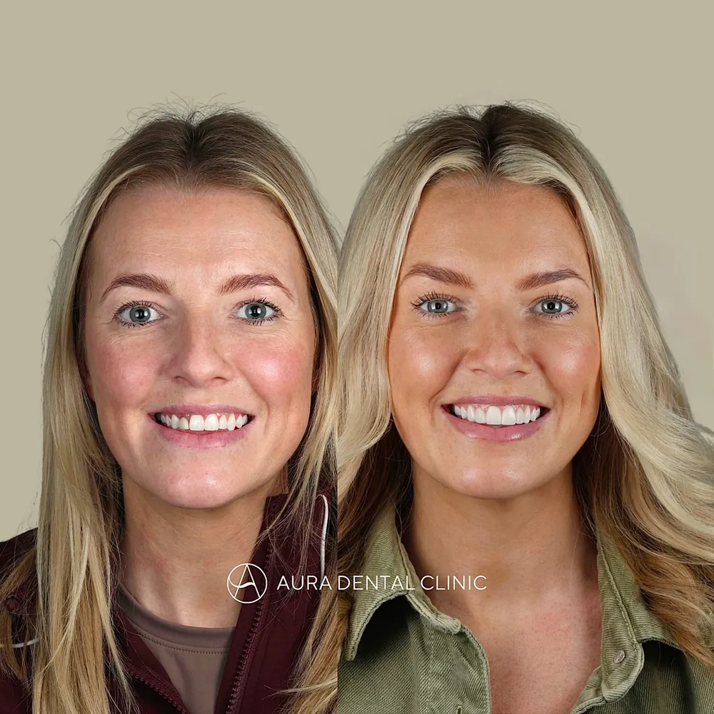 Before and after Halo Veneers smile makeover