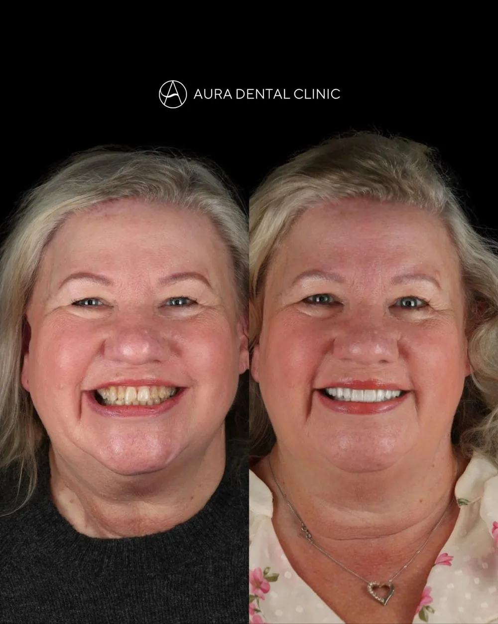 Before and after 22 Halo Veneers
