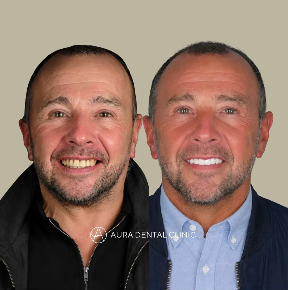 Before and after Halo Veneers for a male patient