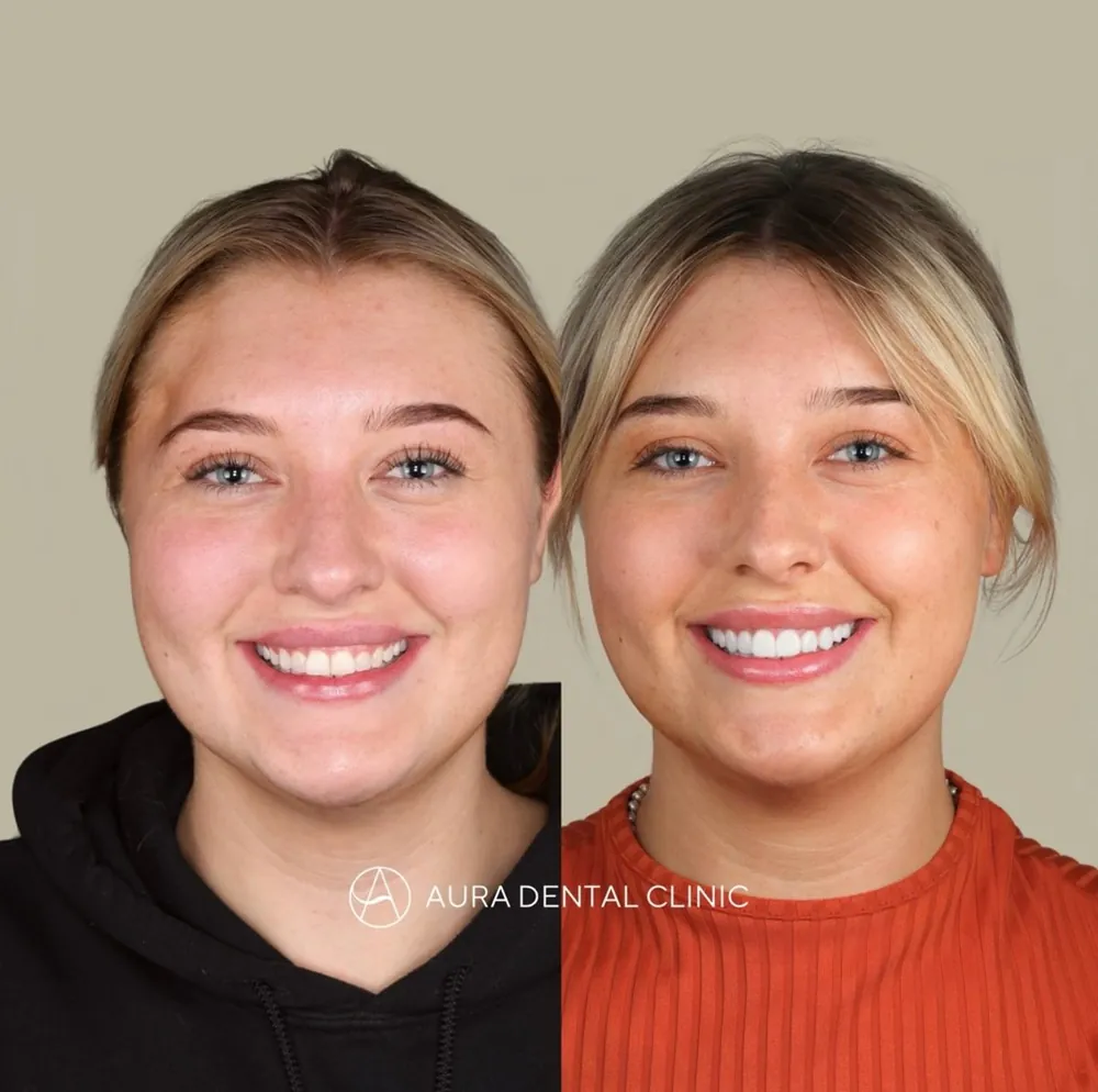 Before and after: Halo Veneers, natural translucency