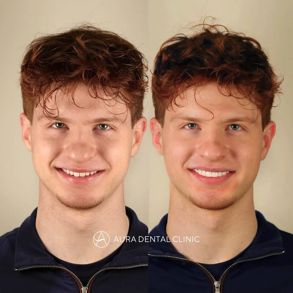 Before and after composite bonding
