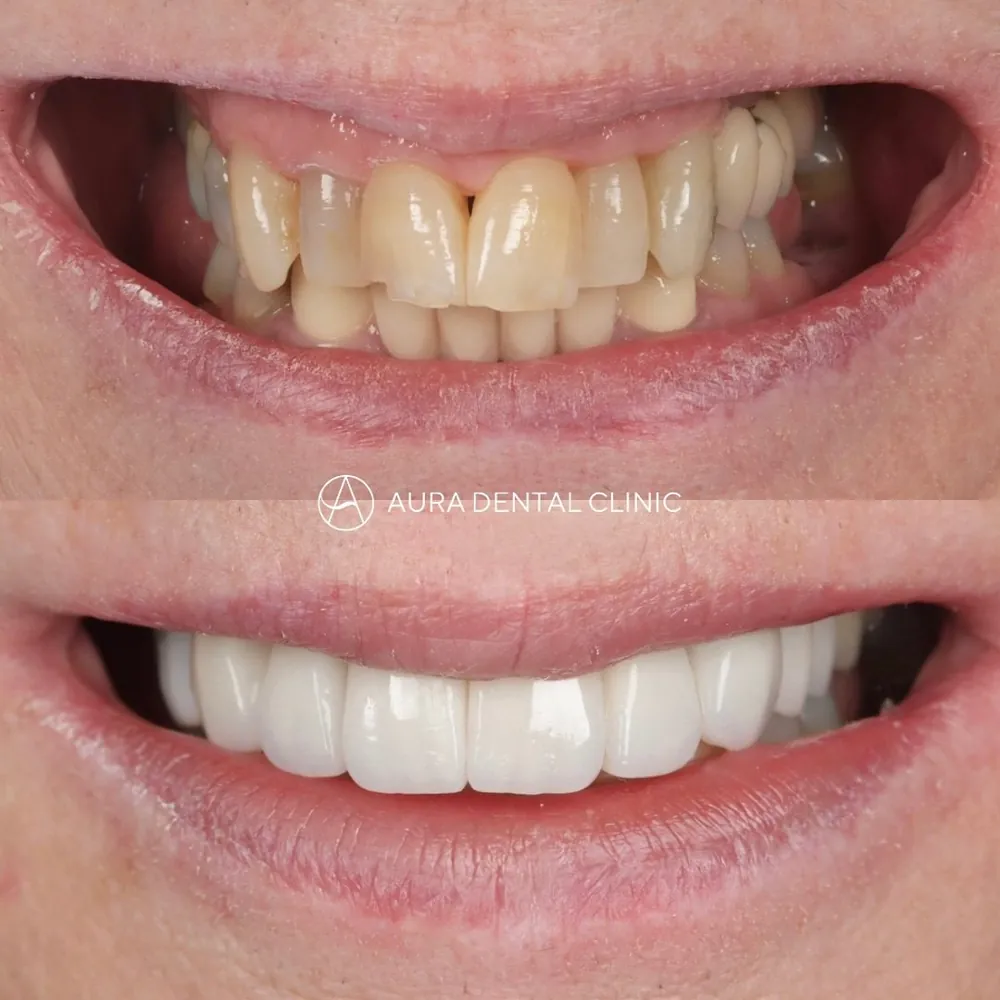 Before and after: Halo Veneers full smile transformation