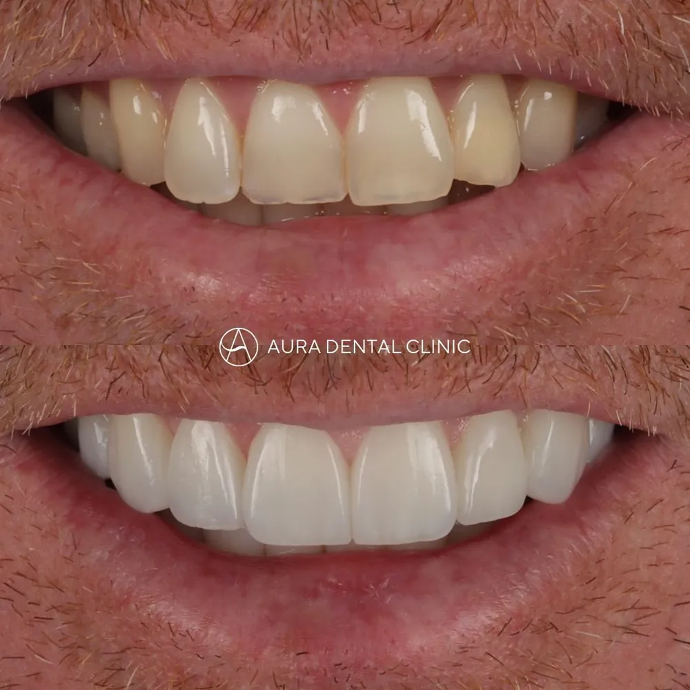 Before and after: 8 ultra-thin Halo Veneers