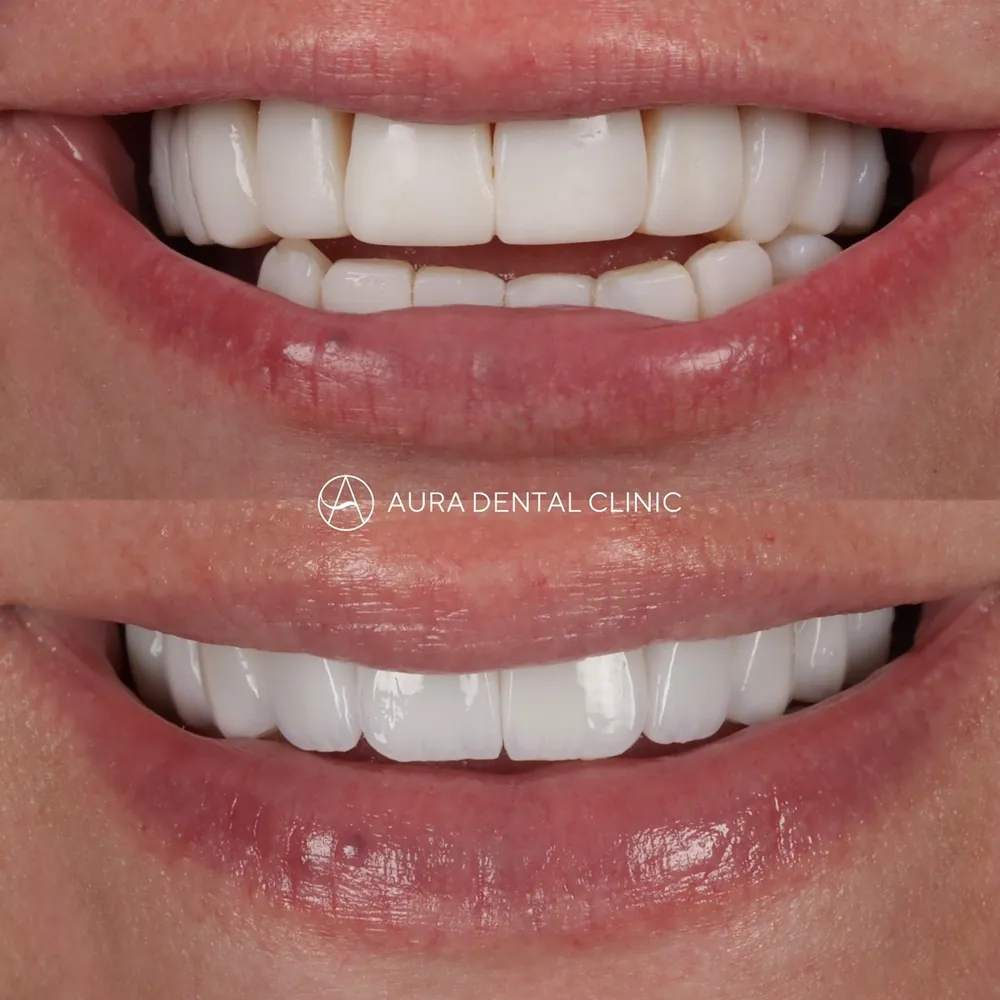 Before and after composite bonding replaced with Halo Veneers
