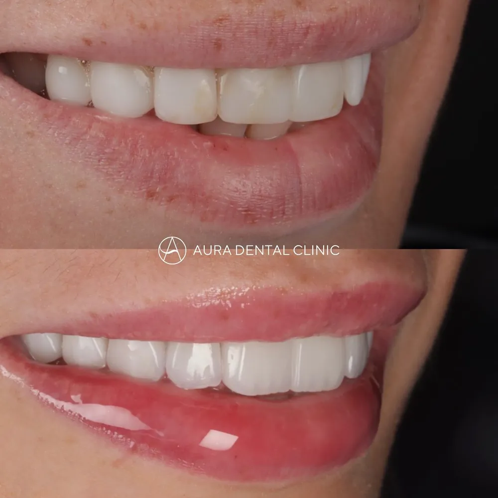 Before and after: Old composite bonding replaced with Halo Veneers