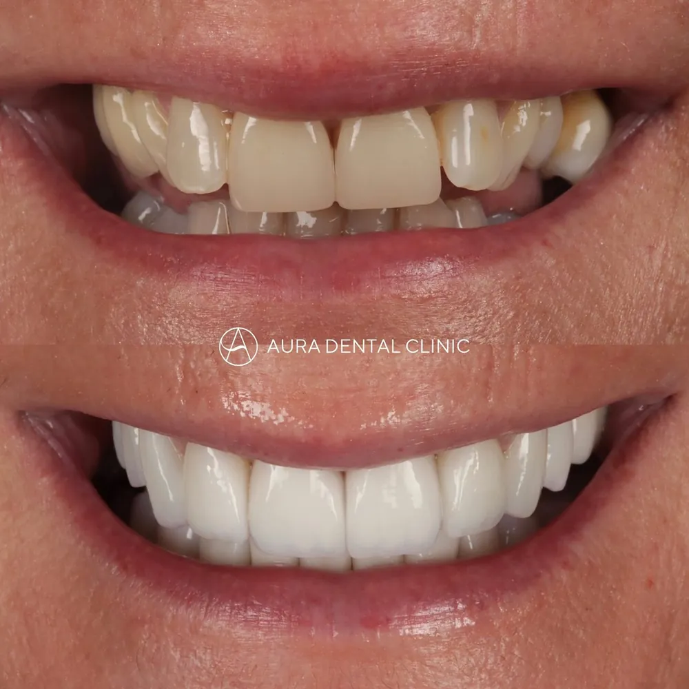 Before and after 20 Halo Veneers restoring worn teeth