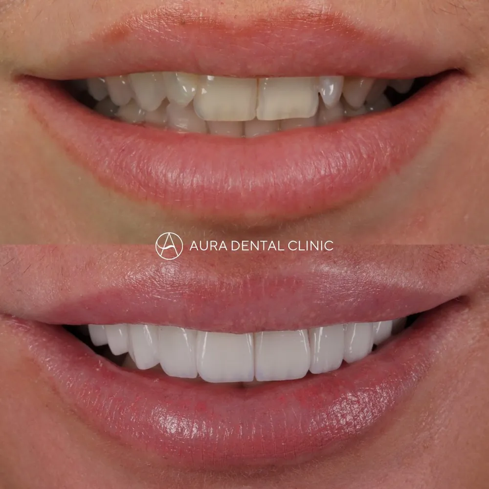 Before and after: Halo Veneers, refined shape and harmony
