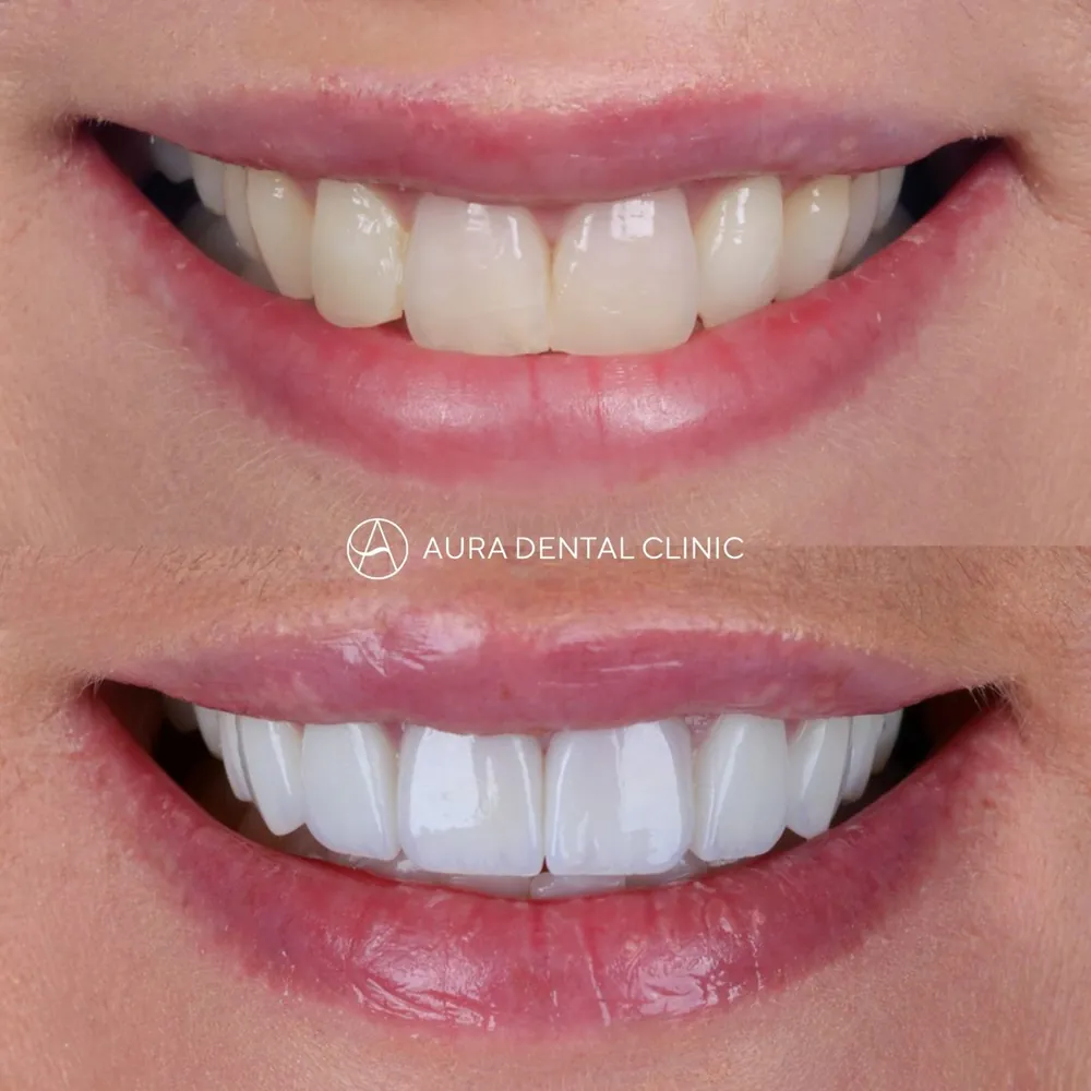 Before and after: 8 Halo Veneers, subtle refinement
