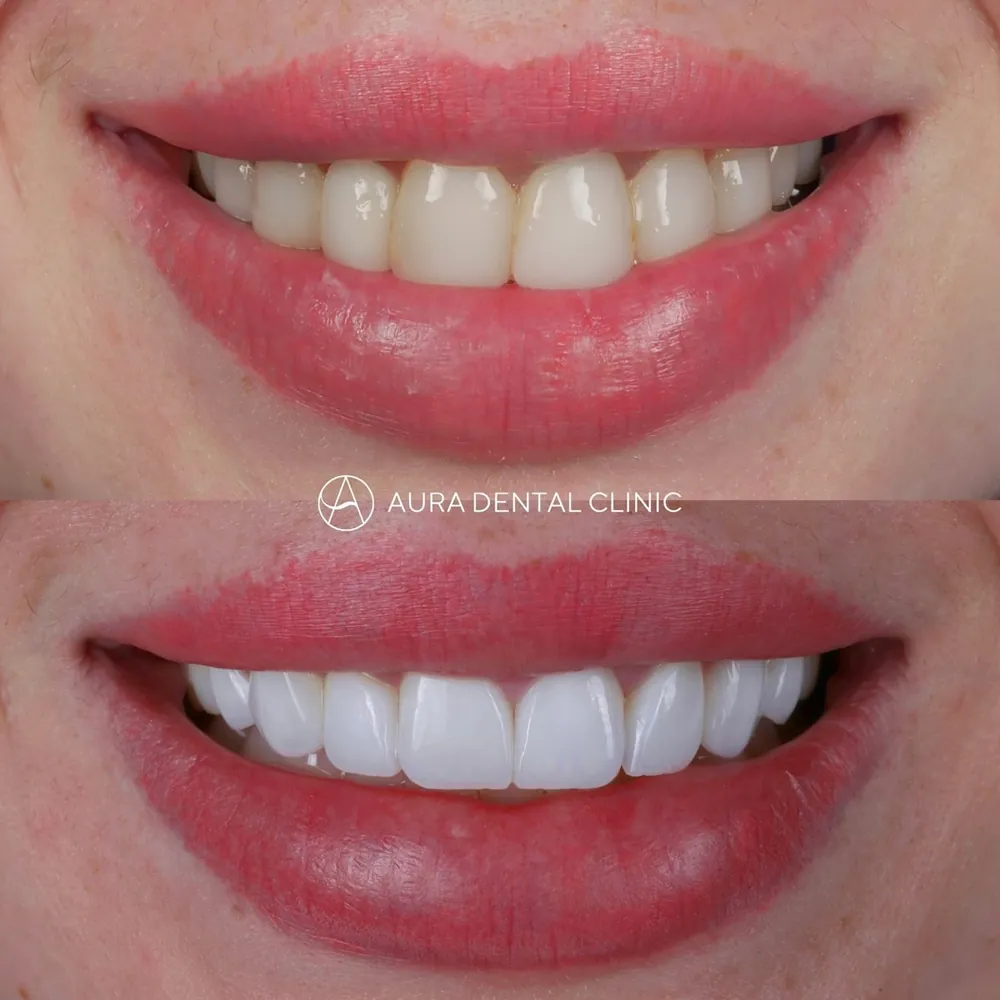 Before and after: Old composite upgraded to Halo Veneers