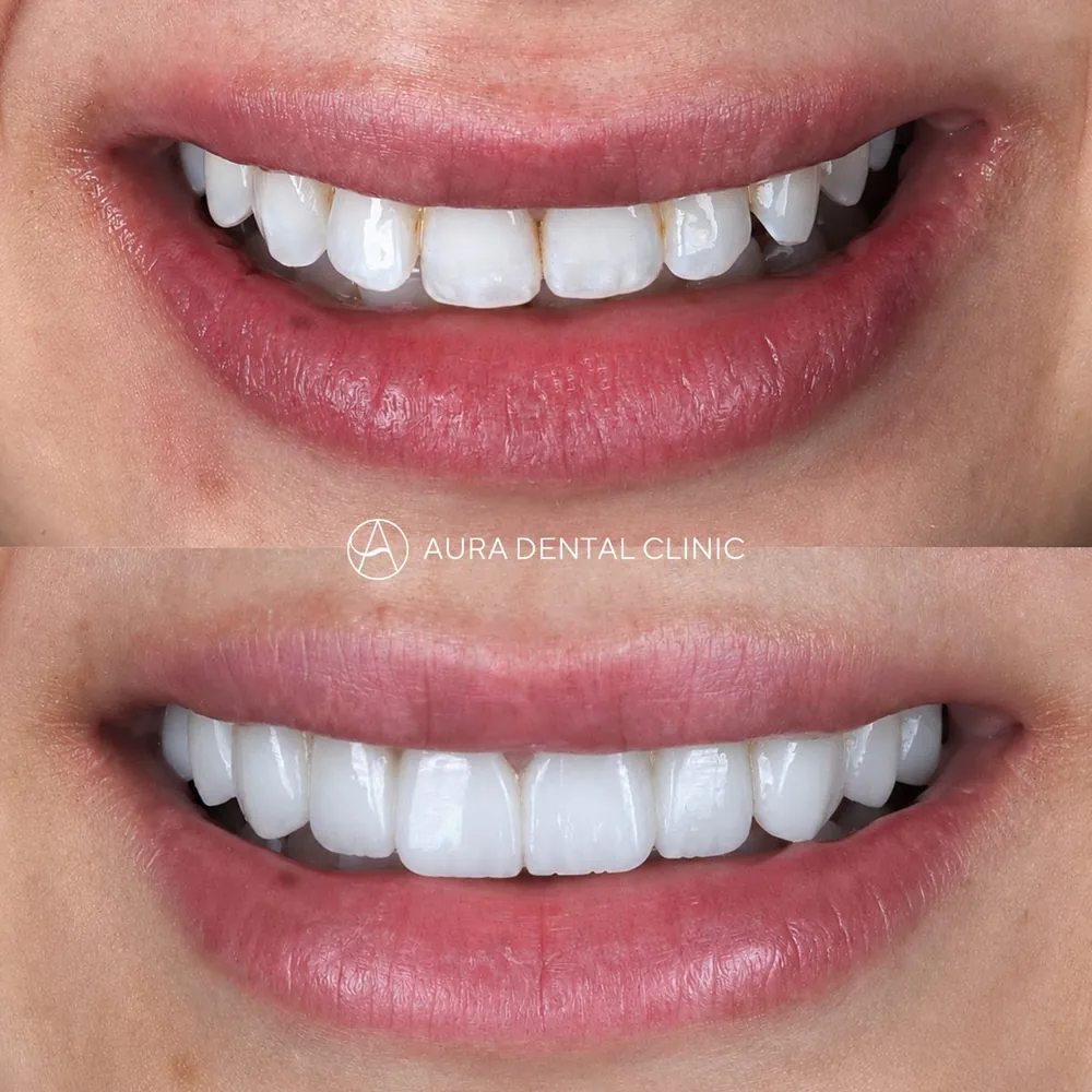 Before and after a full set of Halo Veneers