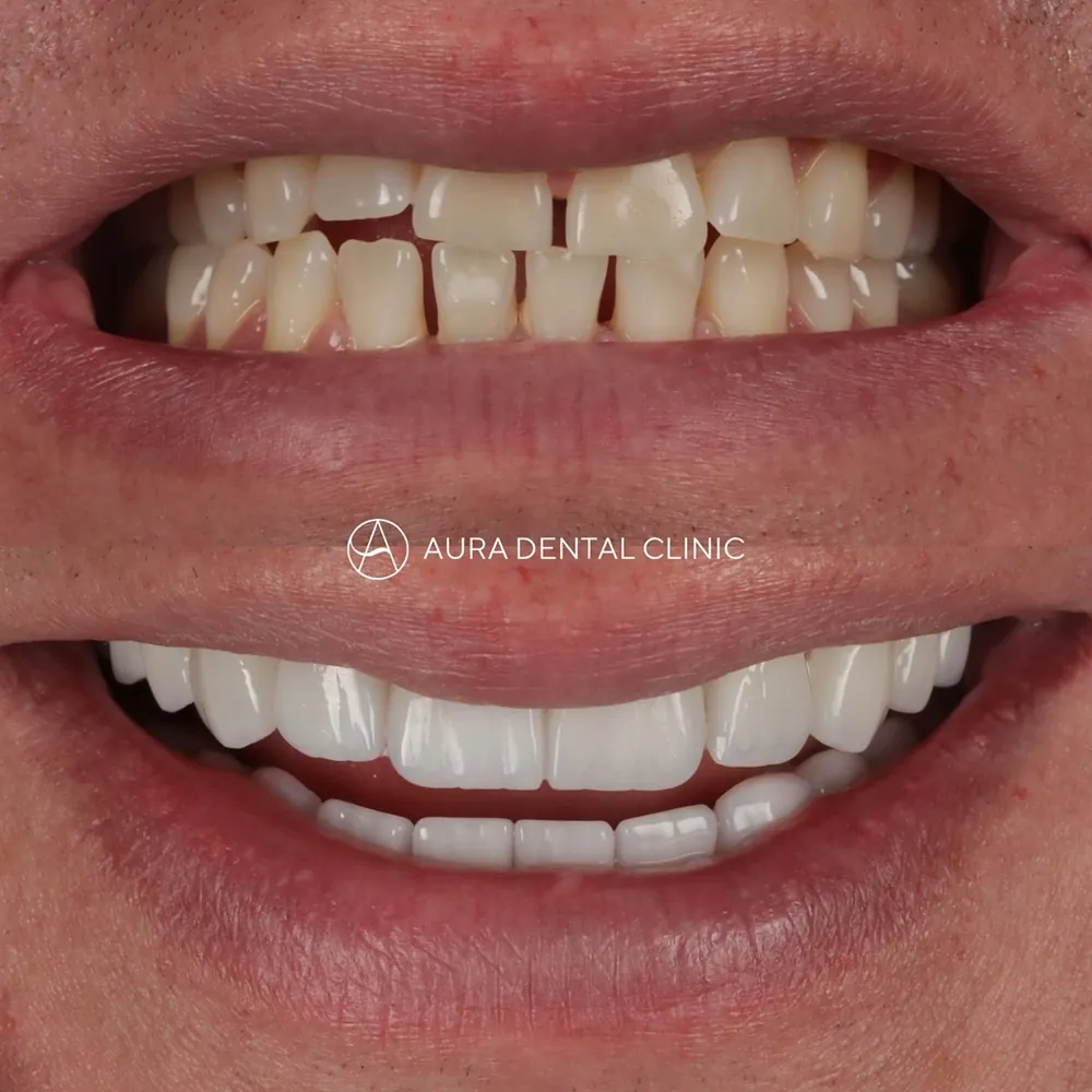 Before and after 20 Halo Veneers