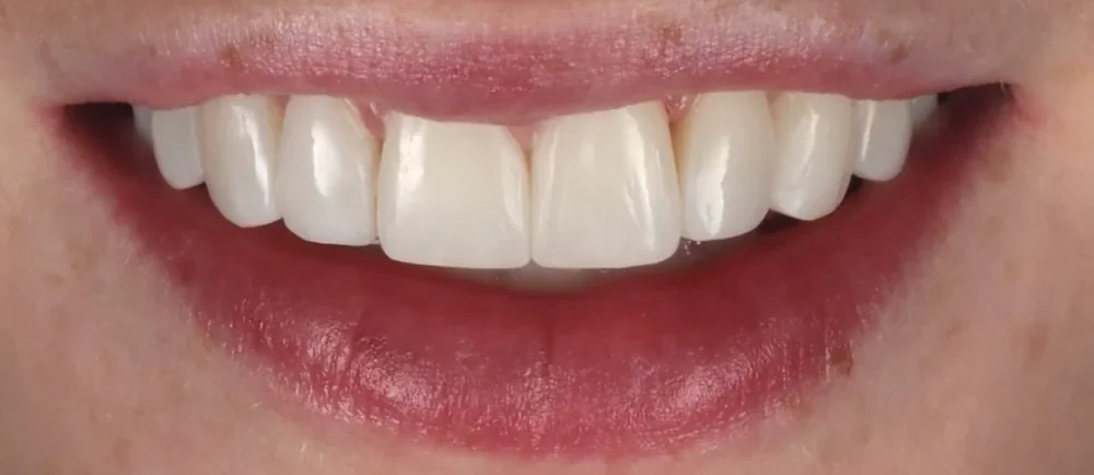 After: straighter, brighter teeth