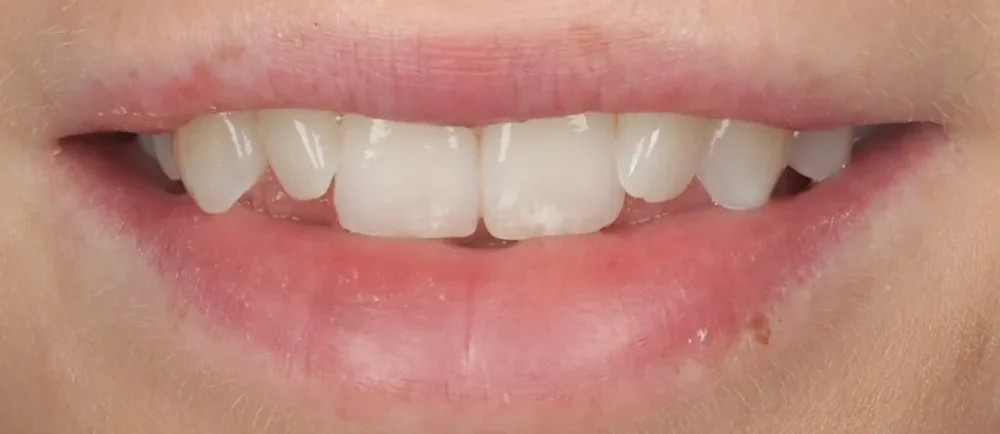 Before: crowded front teeth