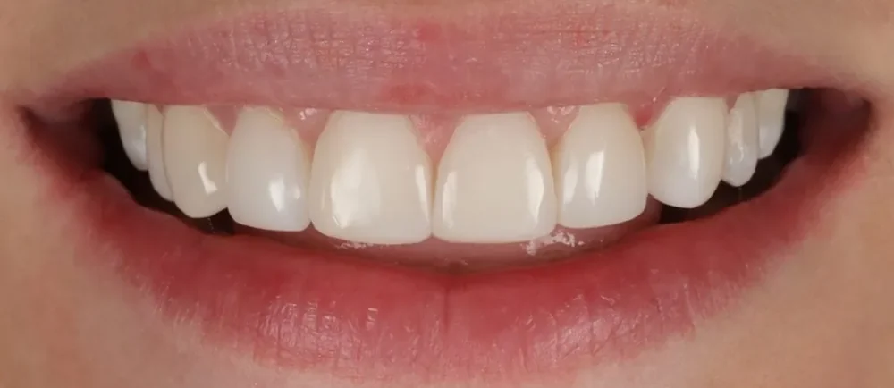 After: straight teeth with 6 bonded