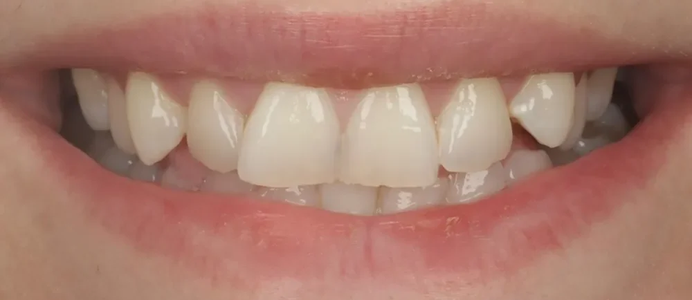 Before: crowded, uneven teeth
