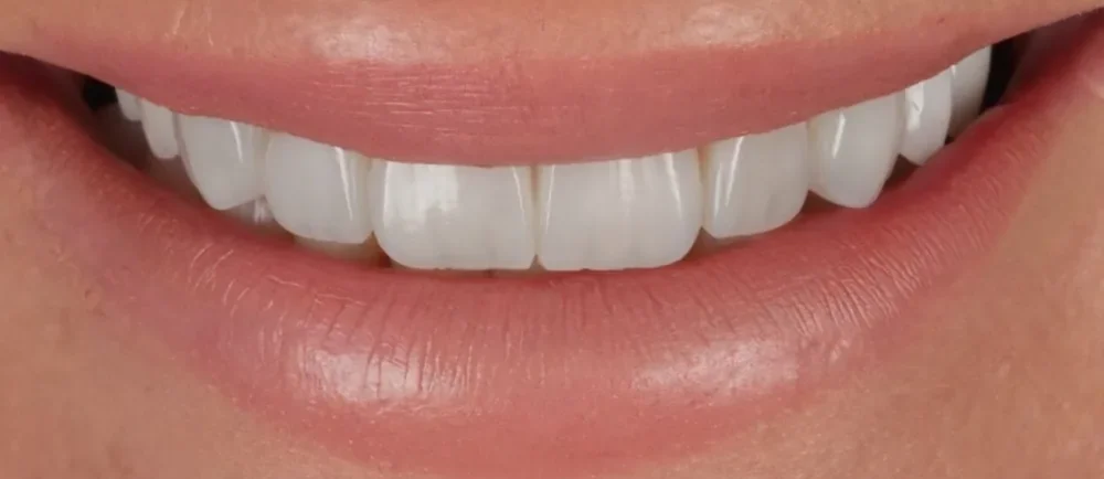 After: straightened teeth finished with Halo Veneers