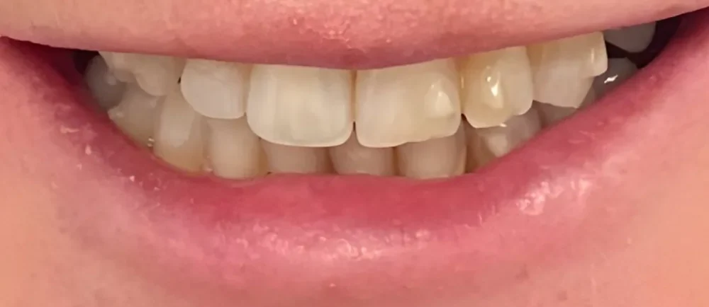 Before: crowded, discoloured teeth