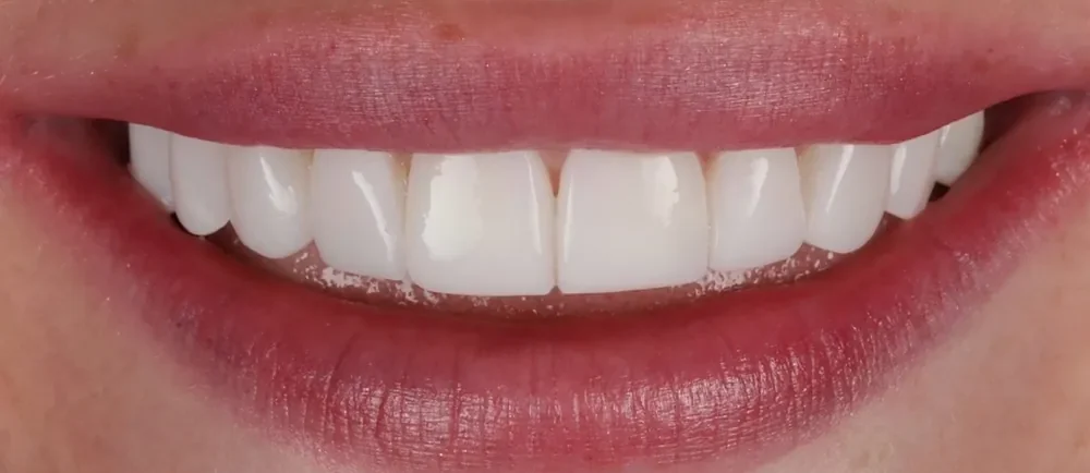 After: 10 composite veneers