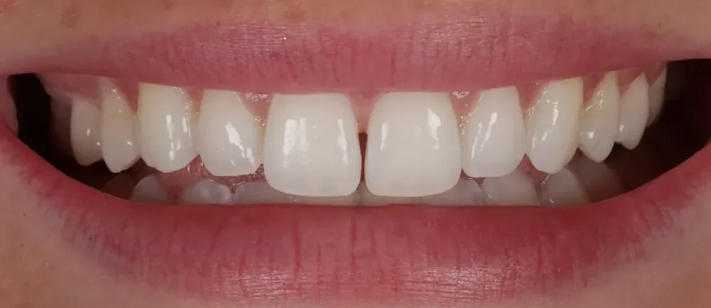 Before: uneven teeth with gaps