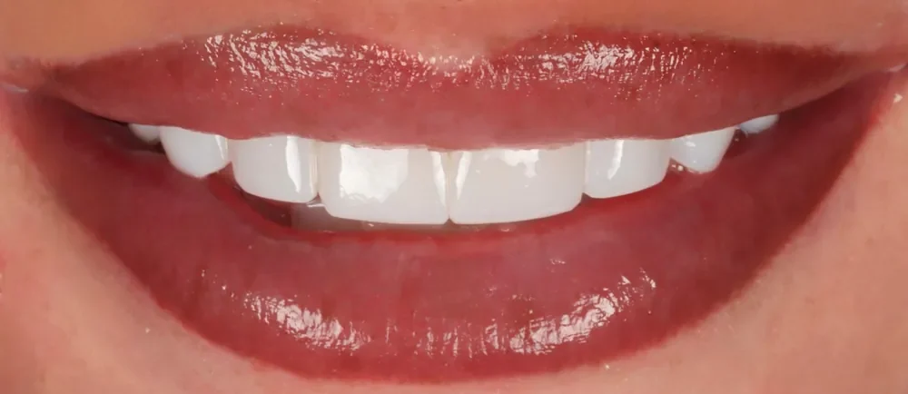 After: brighter, even composite bonding