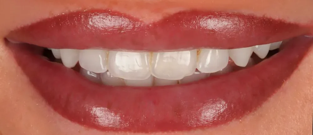 Before: worn, uneven front teeth
