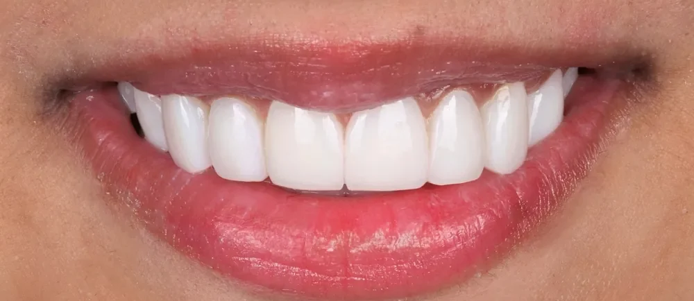 After: a fuller smile with composite veneers