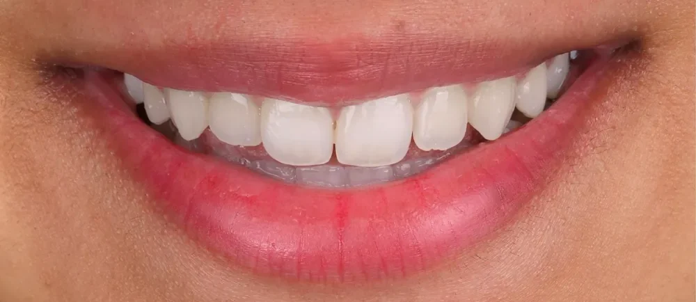 Before: small, uneven teeth