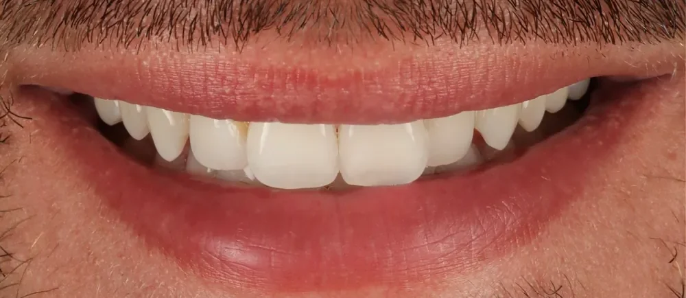 Before: worn tooth edges