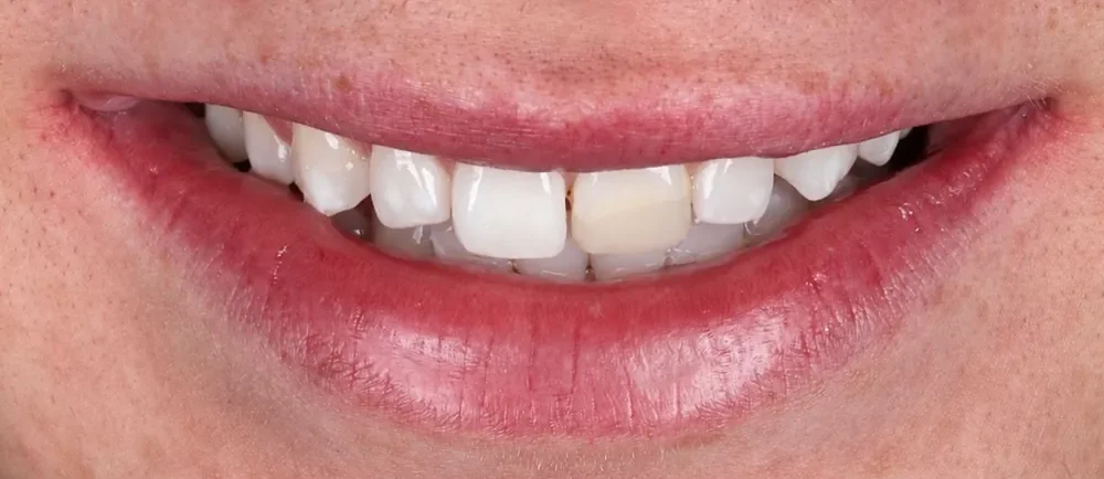 Before: small gaps and uneven edges