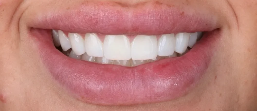 After: the gap closed with bonding