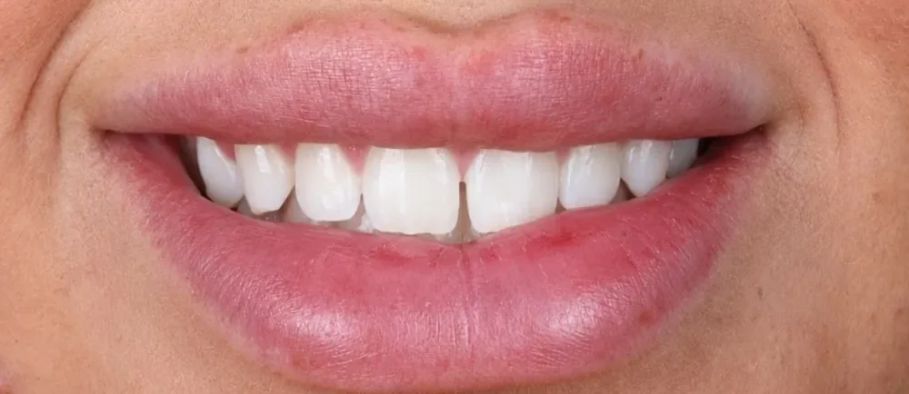 Before: a gap between the front teeth