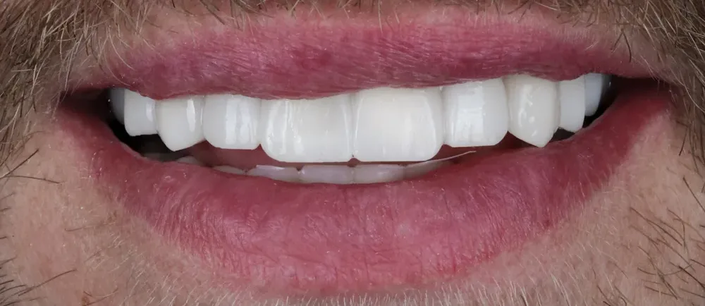After: a full Halo smile