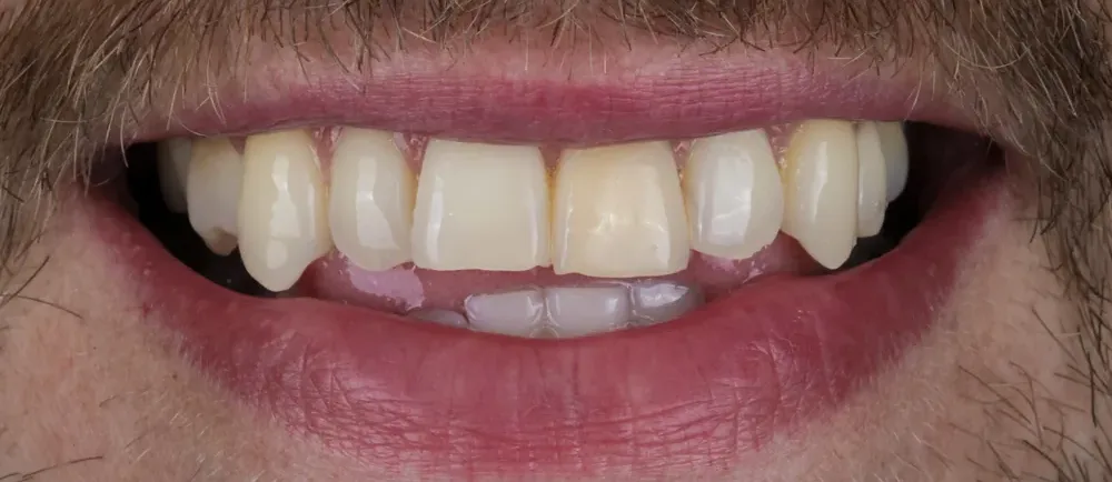 Before: uneven, worn teeth