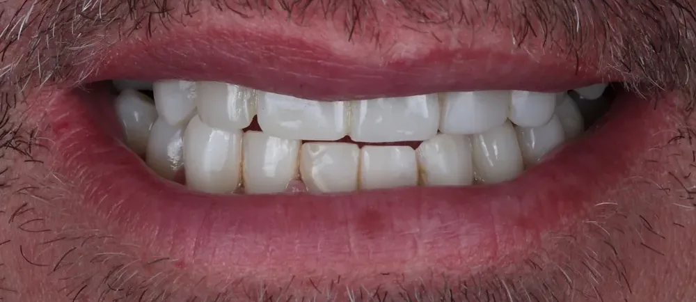 Before: worn, uneven teeth
