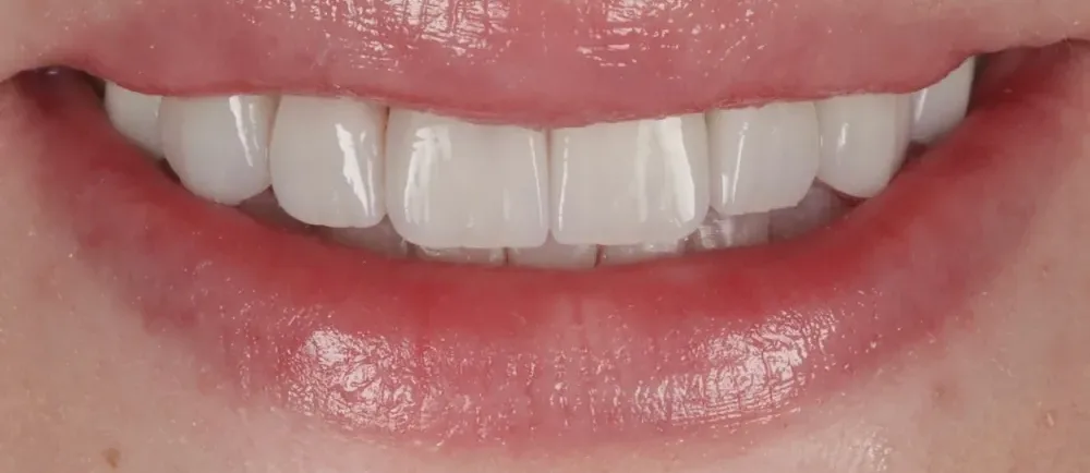 After: natural-looking Halo Veneers