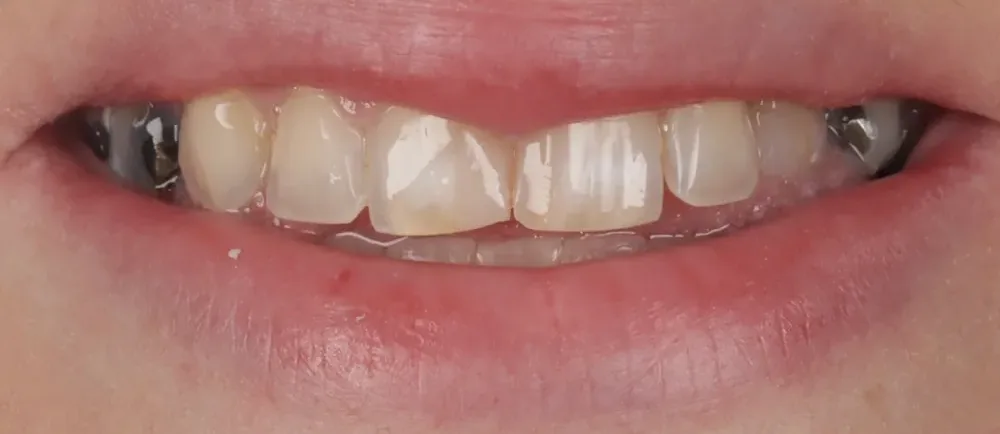 Before: discoloured, uneven teeth