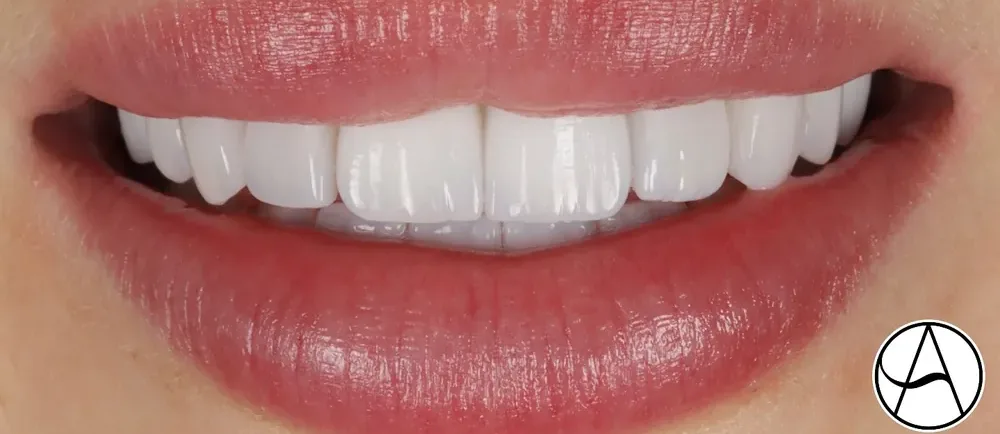 After: longer, balanced Halo Veneers