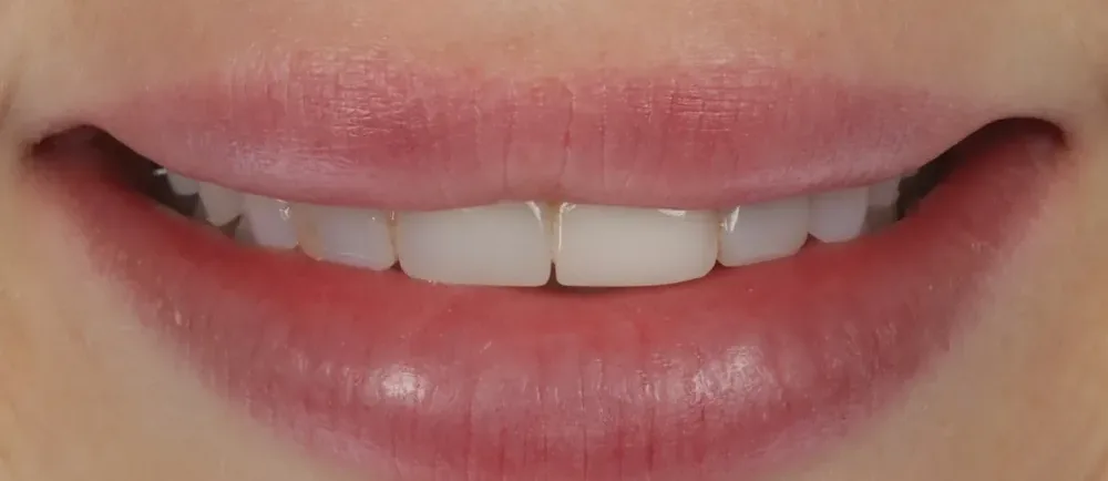 Before: short, uneven teeth