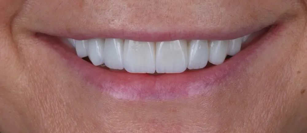 After: natural Halo Veneers